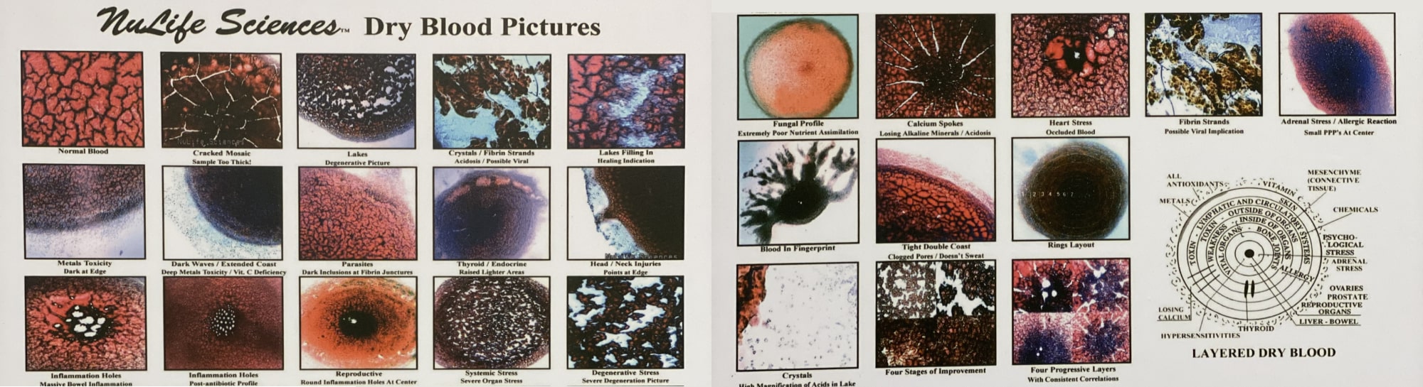 Dried-layer blood cell analysis examples