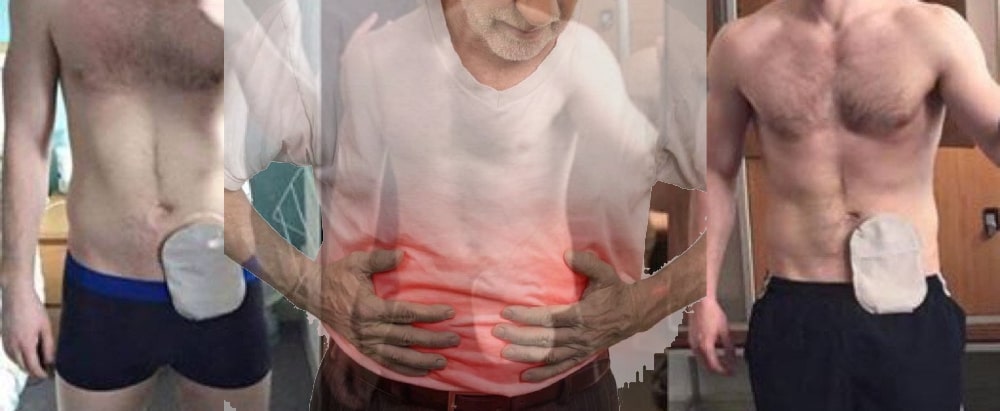 man with crohns disease